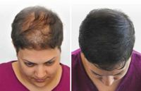 Tricho Pigmentation Scalp Haar-Imitation Haarverdichtung Schleswig-Holstein - Bad Oldesloe Vorschau