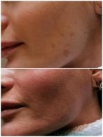 Microneedling - Bb-glow - Gesichtbehandlung Essen - Essen-Stadtmitte Vorschau