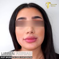 Lippenaufbau/Lippenaufspritzung in der Hamburger Innenstadt Hamburg-Mitte - Hamburg Altstadt Vorschau