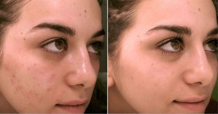 Carbon Laser Peeling Hollywood Peeling Gesichtsbehandlung in Traben-Trarbach