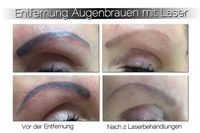 Tattoentfernung mit Yag Laser durch Fachärztin Lindenthal - Köln Weiden Vorschau