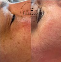 BB glow Microneedling Schulung Niedersachsen - Osnabrück Vorschau