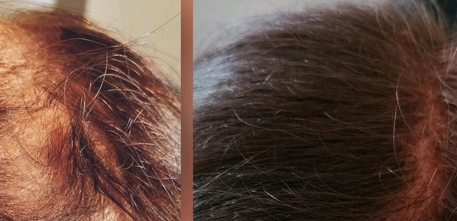 Needling bei Haarausfall, Scalp Kopfhaut Behandlung medical Behan in Großrosseln