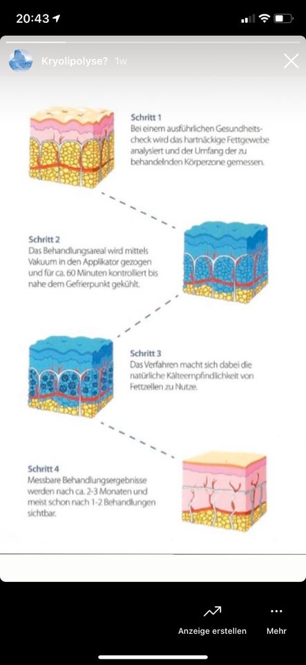 Kryolipolyse Fett verlieren durch Fett einfrieren.❄️ in Essen