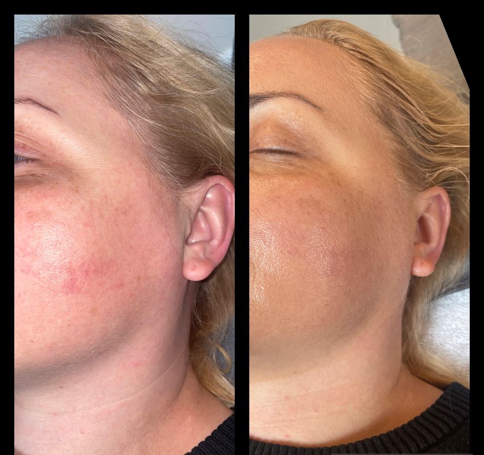 Microneedling , BB-Glow, Gesichtsbehandlung, Beauty in Melbeck in Ebstorf