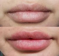 Po Vergrößerung ohne OP, Lippenunterspritzung b. Botox ,Fadenlift Hessen - Offenbach Vorschau