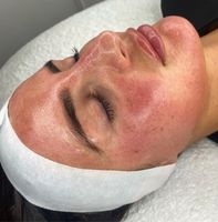 MICRONEEDLING GESICHTSBEHANDLUNG Nordrhein-Westfalen - Düren Vorschau