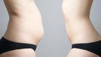 Kryolipolyse, Kälte gegen Fett, Bodyforming, Fettreduktion Nordrhein-Westfalen - Ibbenbüren Vorschau