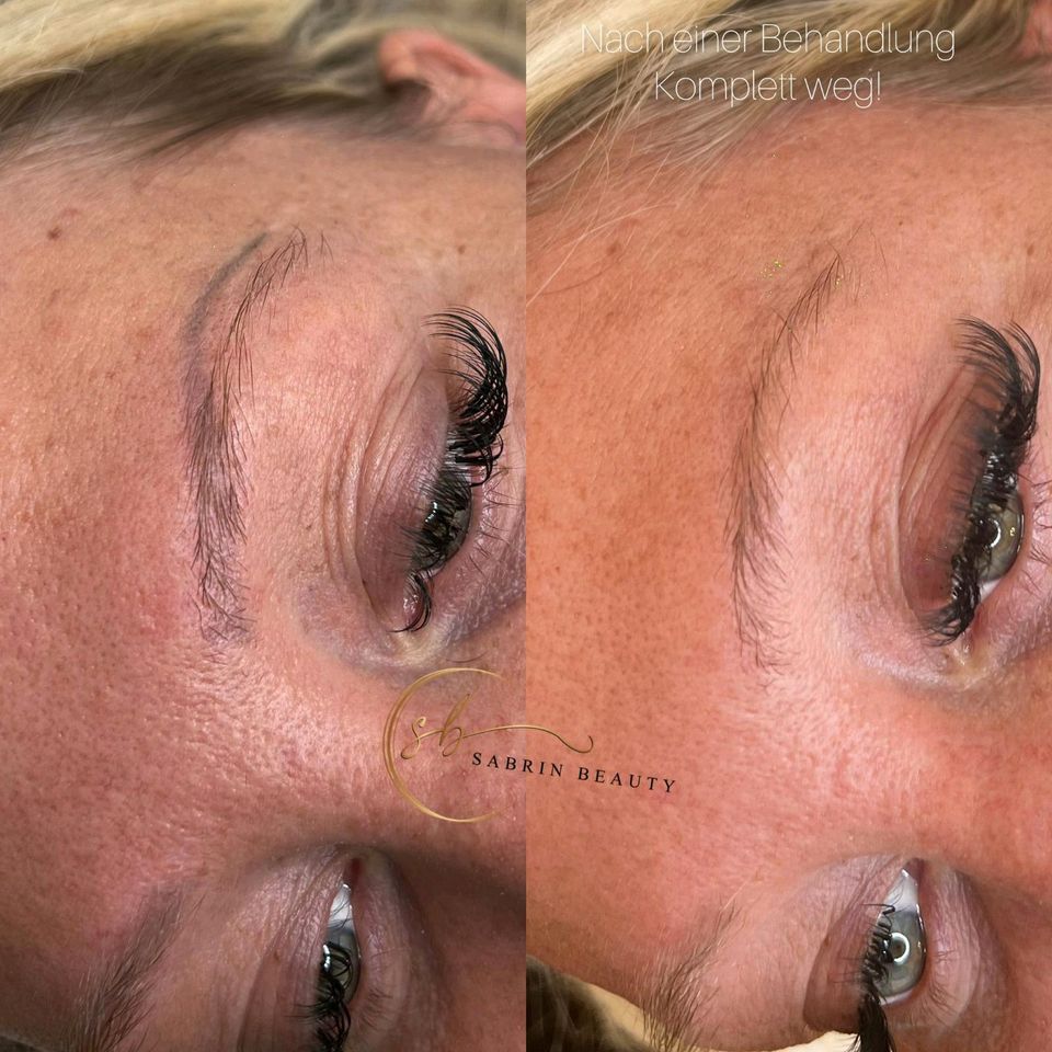 Entfernung microblading permanent Make-up Tattoos Remover in Bottrop