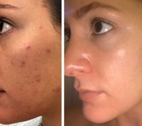 Microneedling + BB-Glow Angebot Berlin - Mitte Vorschau