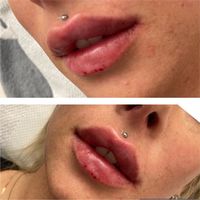 Lippenunterspritzung |Faltenunterspritzung | Contouring Hamburg-Mitte - Hamburg Neustadt Vorschau