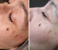 Aqua Facial / Microneedling Kombischulung Niedersachsen - Elze Vorschau