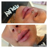 Lippenunterspritzung * Faltenunterspritzung * Contouring Hamburg-Mitte - Hamburg Neustadt Vorschau