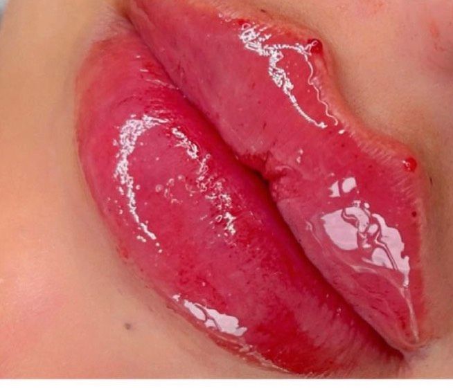 Lippen Aufspritzen , Lippenunterspritzung in Köln