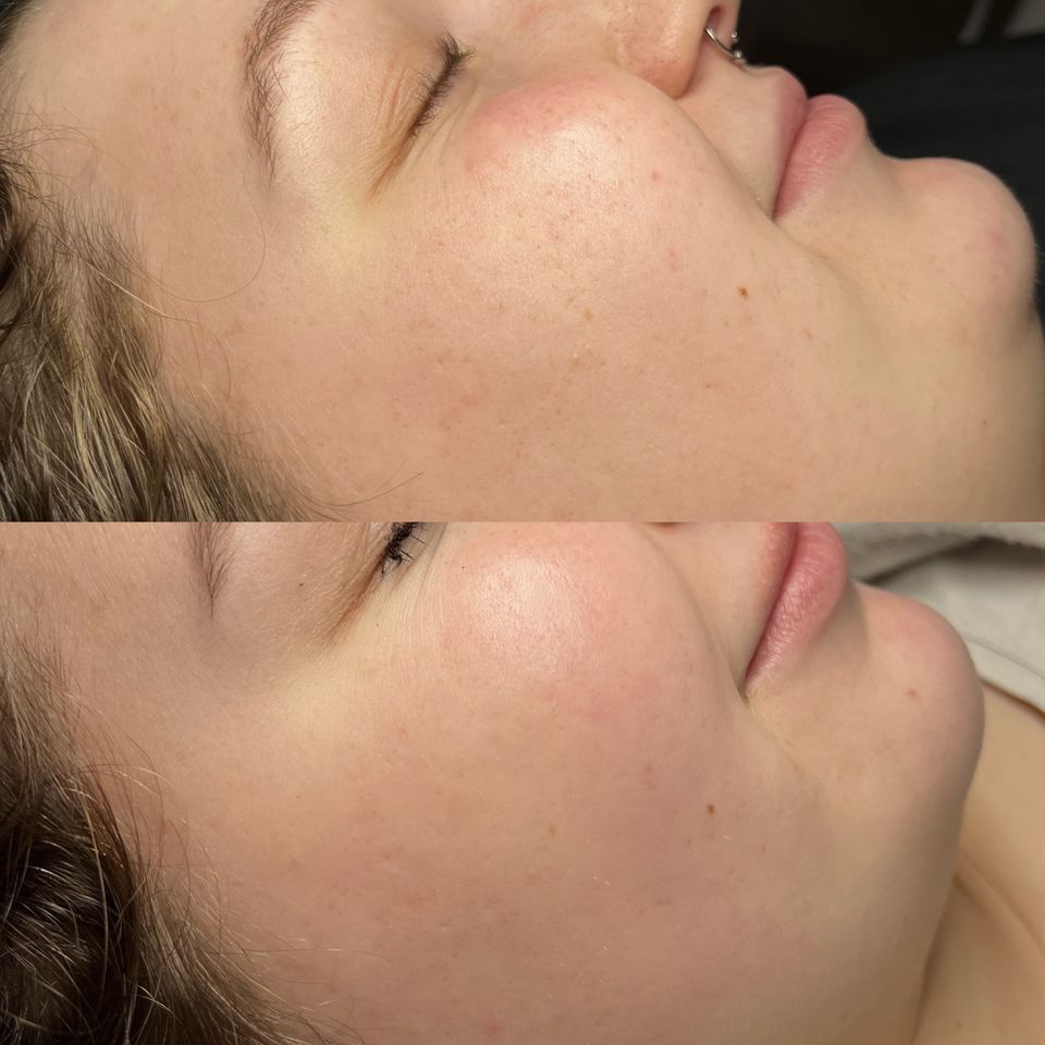 BB Glow / Microneedling in Hannover