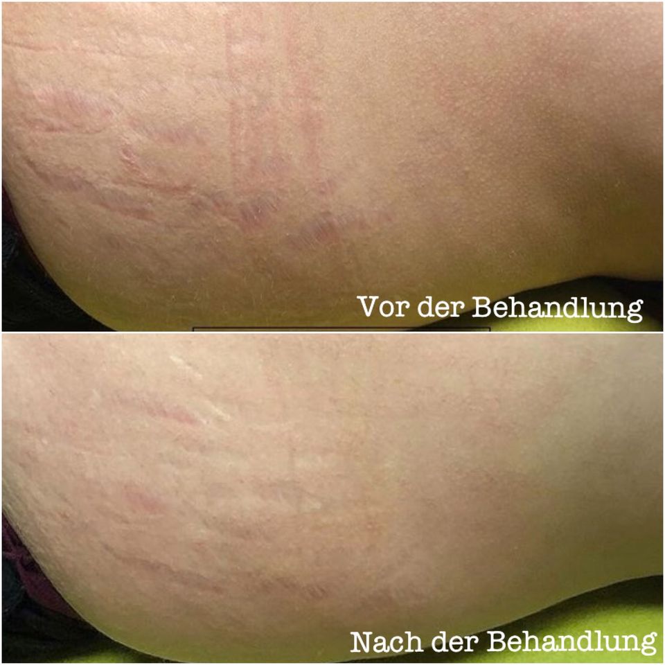 Microneedling und Plasma Pen Kombi Schulung mobil in Osnabrück