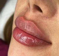 LIPPEN AUFSPRITZEN | LIPPENUNTERSPRITZUNG Innenstadt - Köln Altstadt Vorschau