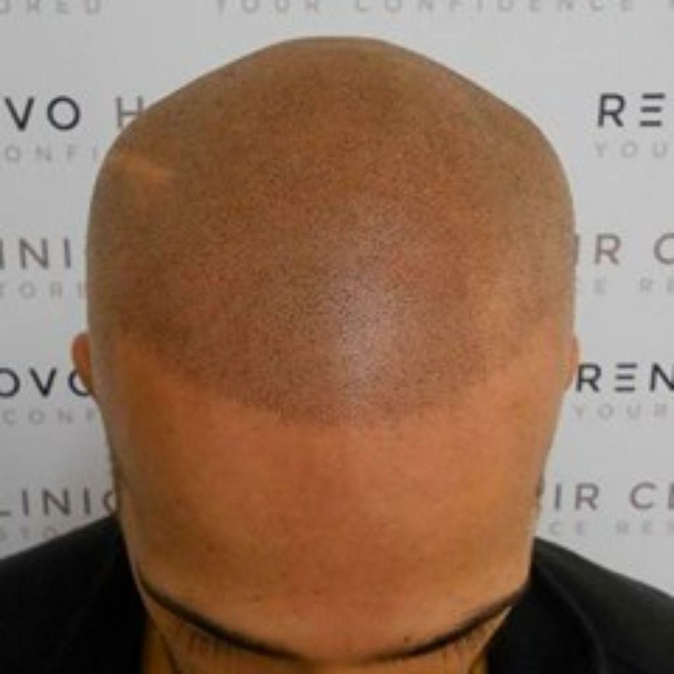 Kopfpigmentierung Haarimitation Glatzen Narbenkaschierung in Bad Oldesloe