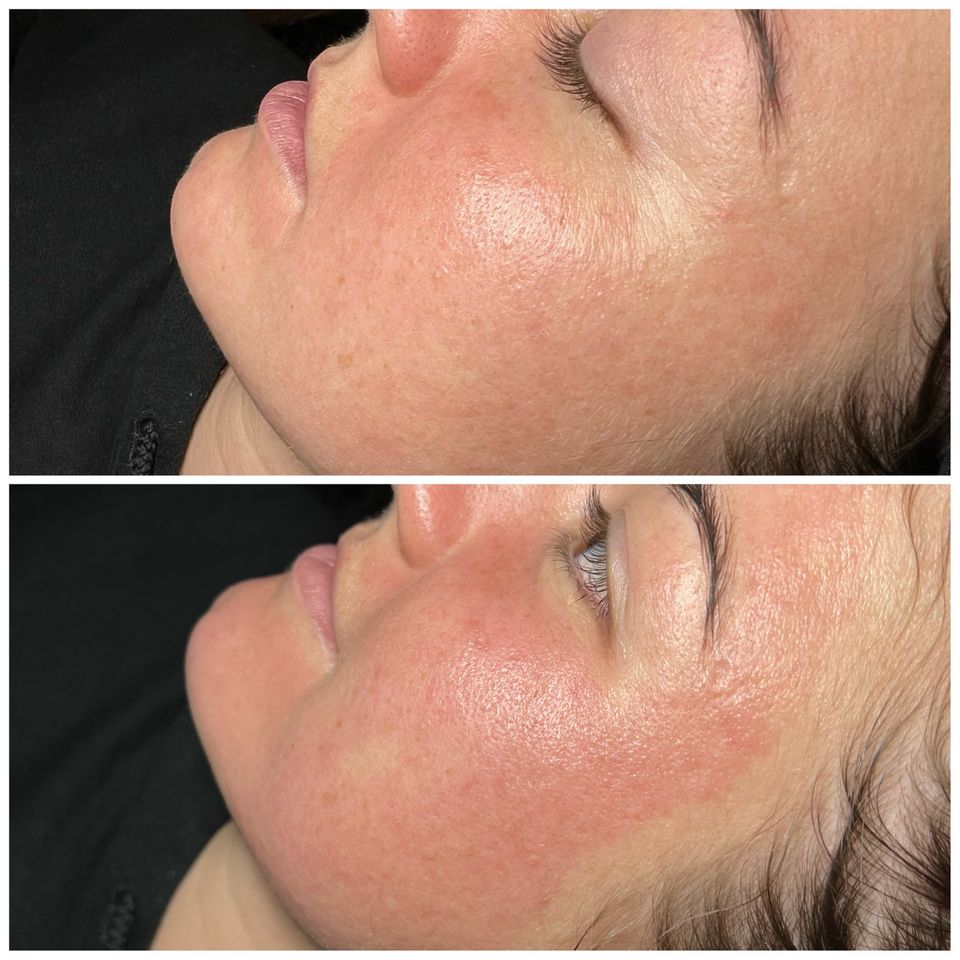 BB Glow / Microneedling in Hannover