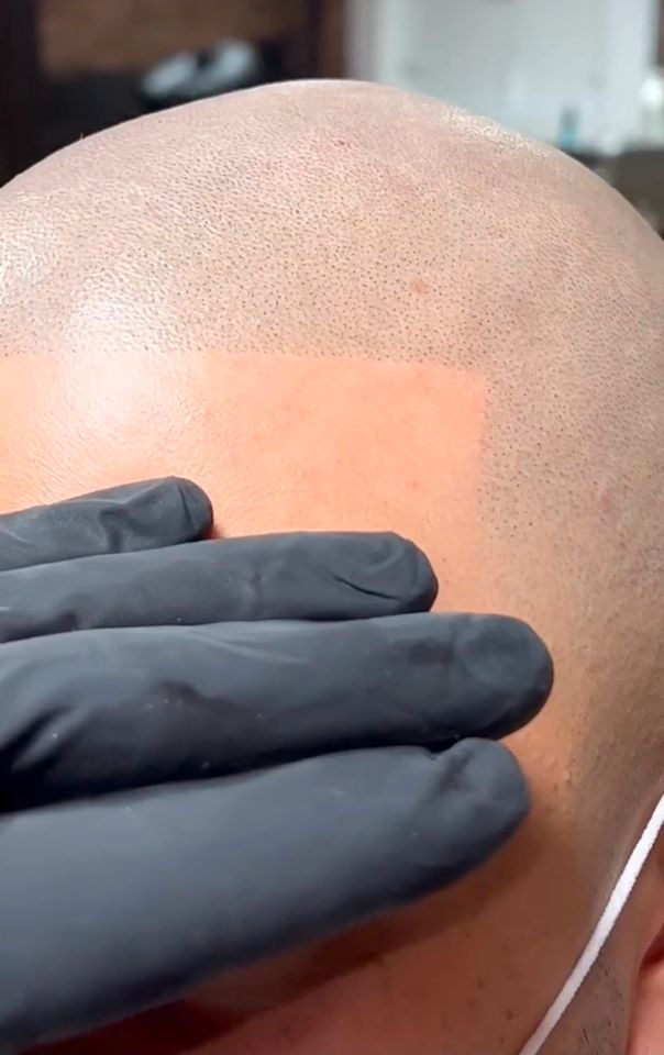 Haarpigmentierung Hair Tattoo in Rosenheim SMP Scalp Micro Pigmentation Haartätowierung Haar Pigmentierung Rosenheim in Rosenheim