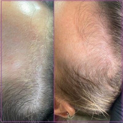 Microneedling Behandlung Haarausfall in Hannover