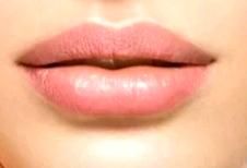 Russian Lips, Hyaluron, Filler, Lippenunterspritzung, Falten in Duisburg