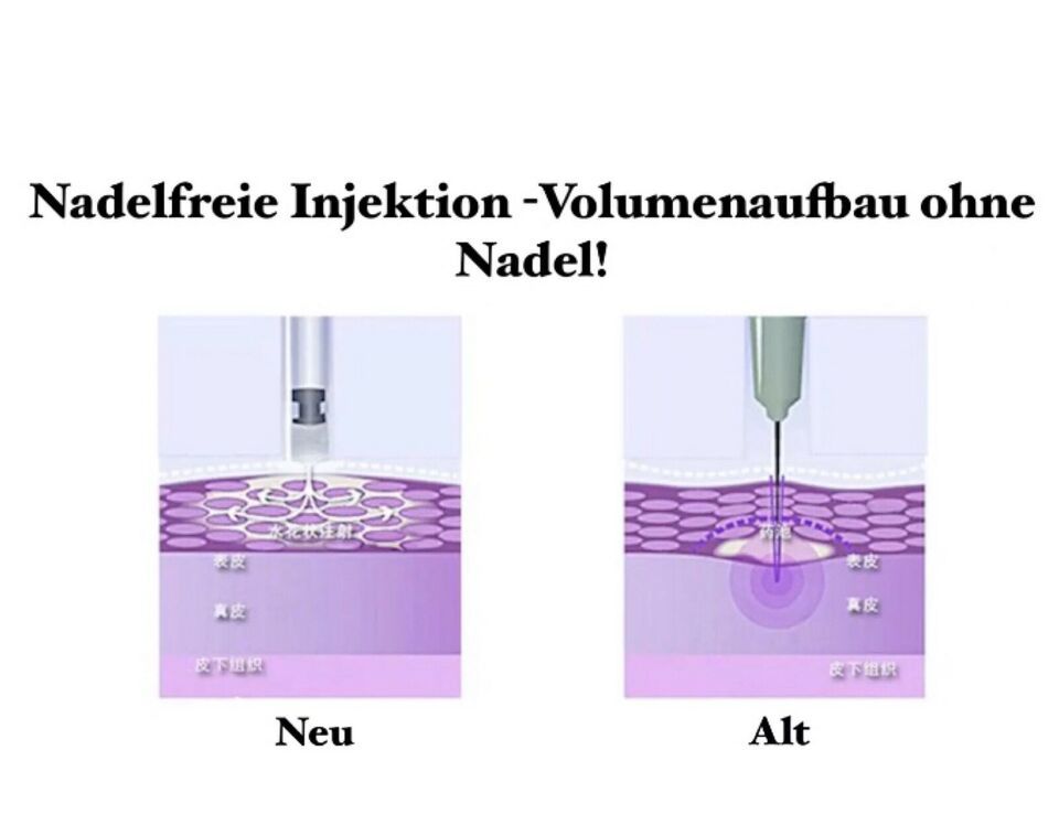 HYALURON - Aufpolsterung - 1 ml / Lippen - Nase - Falten in Paderborn