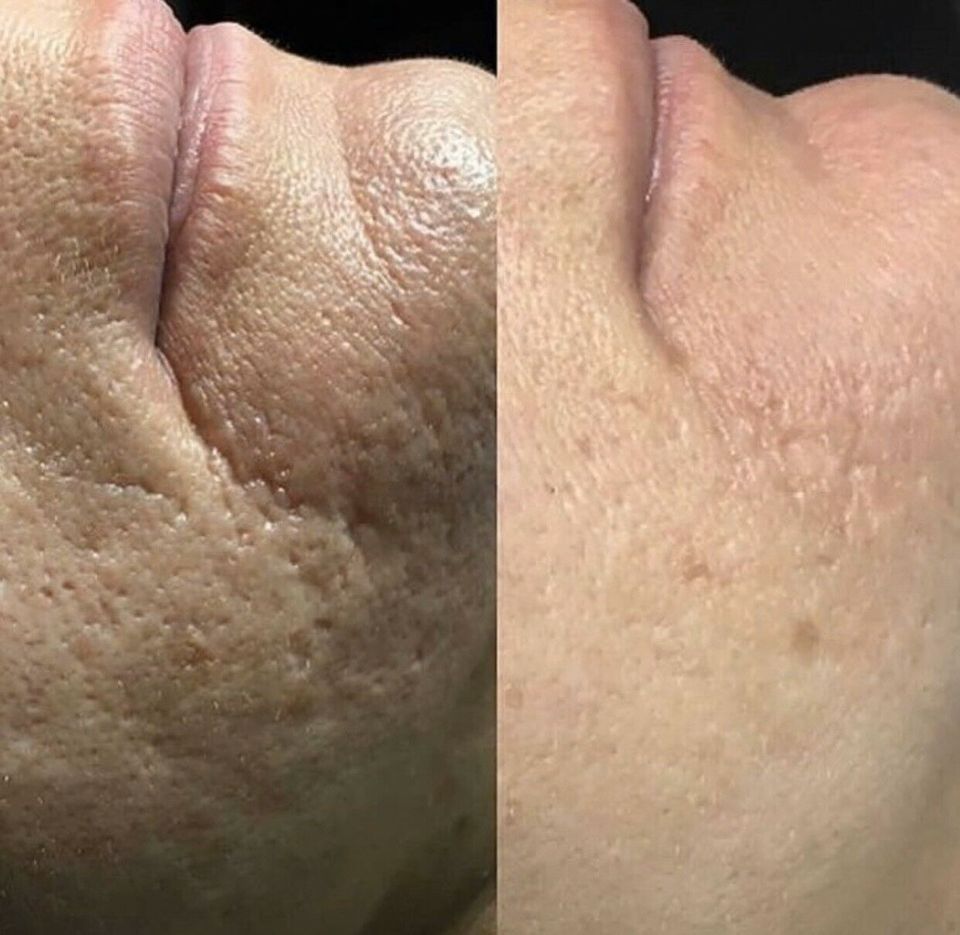 Microneedling in Nürnberg (Mittelfr)