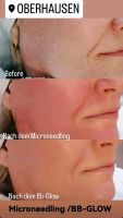 Microneedling-Bb Glow-Bb Lips Nordrhein-Westfalen - Mülheim (Ruhr) Vorschau