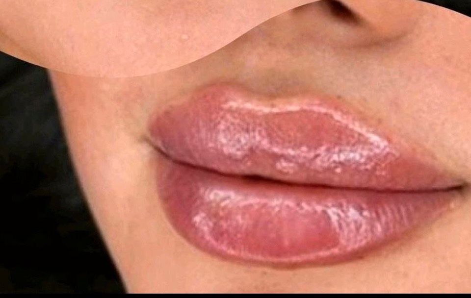 Russian Lips Lippenunterspritzung, Hyaluron Unterspritzungen in Hamburg