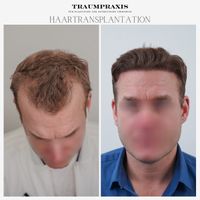 Haartransplantation in Hamburg Aktion Ab 1500€ Hamburg-Mitte - Hamburg Altstadt Vorschau