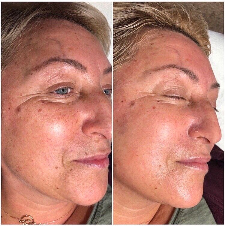 Microneedling BB Glow Vitamin Brows Schulung mobil in Osnabrück