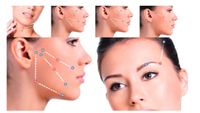 PDO-Fadenlifting * Softlifting * Facelift * Browlift Hamburg-Mitte - Hamburg Neustadt Vorschau