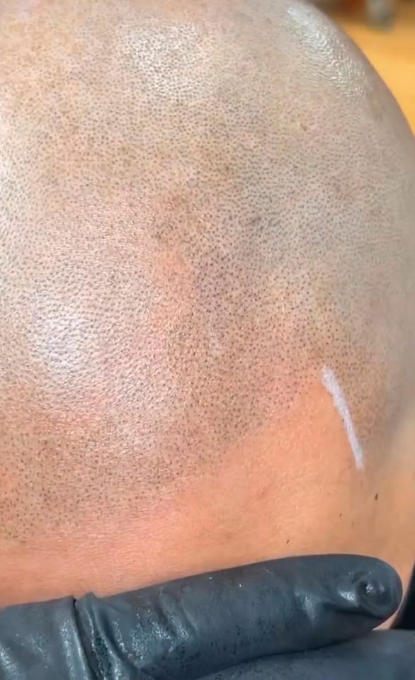 Haarpigmentierung Hair Tattoo in Rosenheim SMP Scalp Micro Pigmentation Haartätowierung Haar Pigmentierung Rosenheim in Rosenheim