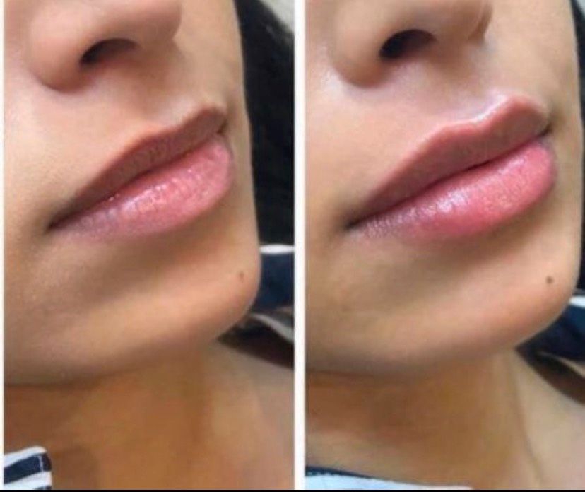 99 € Aktion Hyaluron Filler Lippen Volumenaufbau Falten Russian in Duisburg