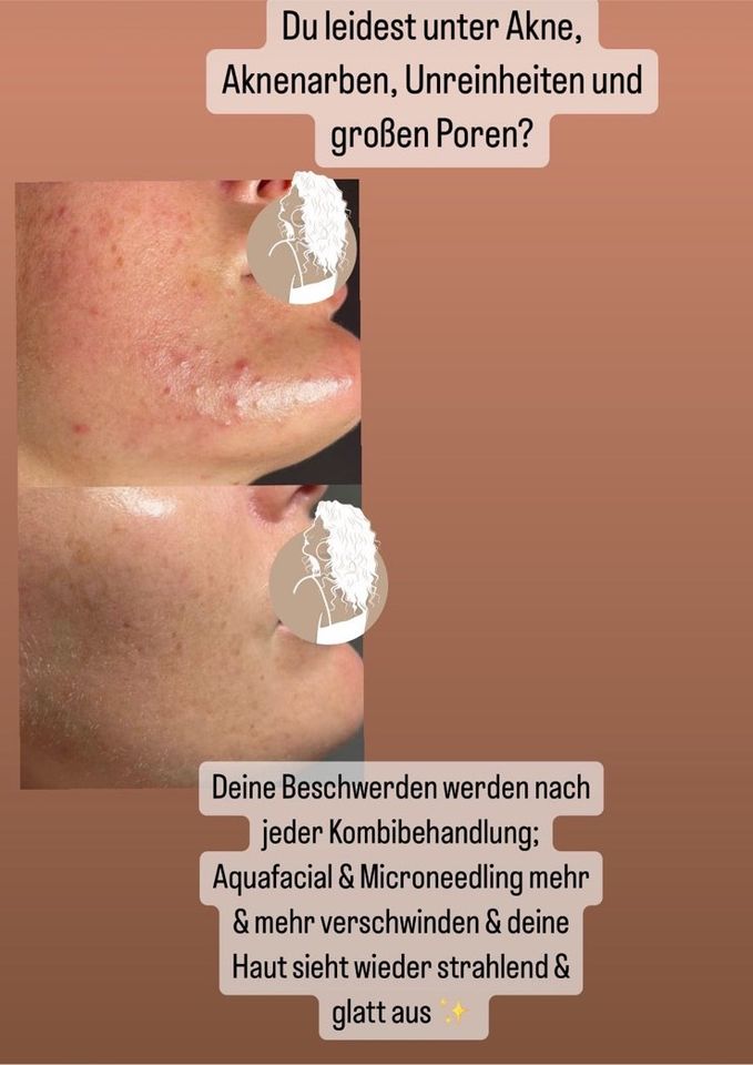 Microneedling- Gesichtsbehandlungen und Schulungen in Bad Fallingbostel