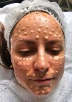 Microneedling-Bb Glow Schulung Nordrhein-Westfalen - Oberhausen Vorschau