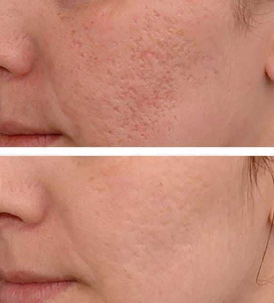 Microneedling Meso  mit Microdermabrasion und Heimpflege Produkte in Barsinghausen