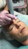 Gesichtsbehandlung mit Mikro-Needling / Micro-Needling Duisburg - Duisburg-Süd Vorschau