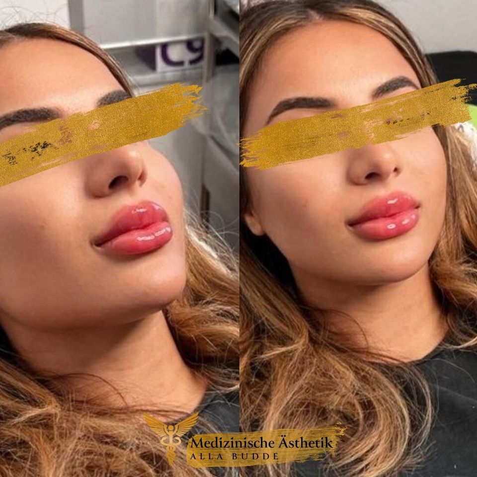 Russian Lips Unterspritzung / Schöne volle Lippen in Ganderkesee