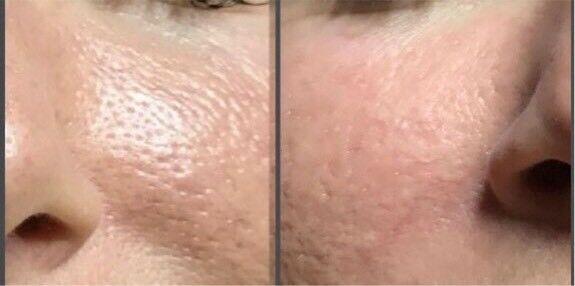 Super Hydratation BB Glow Skin Treatment & Antti Aging Schulung in Bad Vilbel