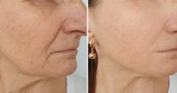 Mesotheraphie  Anti-Aging Bremen - Neustadt Vorschau