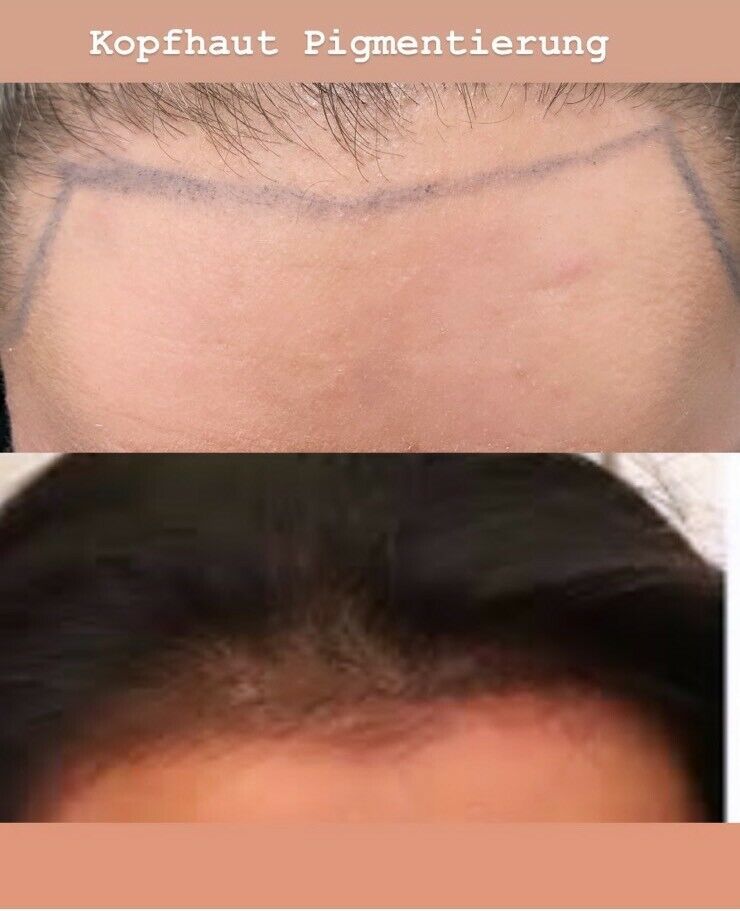 Kopfhautpigmentierung -Scalp -Haarneedling Schulung in Bad Vilbel