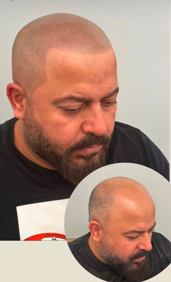 Haarpigmentierung Hair Tattoo in Rosenheim SMP Scalp Micro Pigmentation Haartätowierung Haar Pigmentierung Rosenheim in Rosenheim