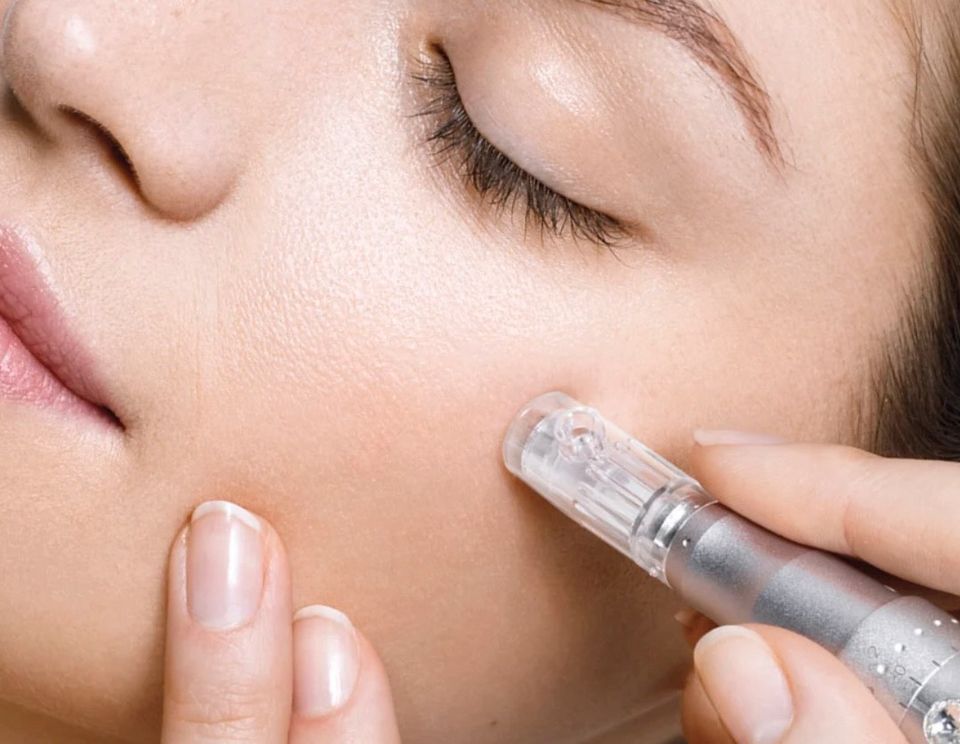 Microneedling gegen Falten, Pigmentflecken in Schliersee