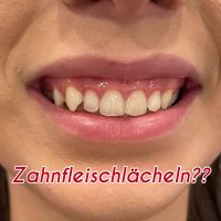 Gummy smile, Zahnfleischlächeln Niedersachsen - Alfeld (Leine) Vorschau