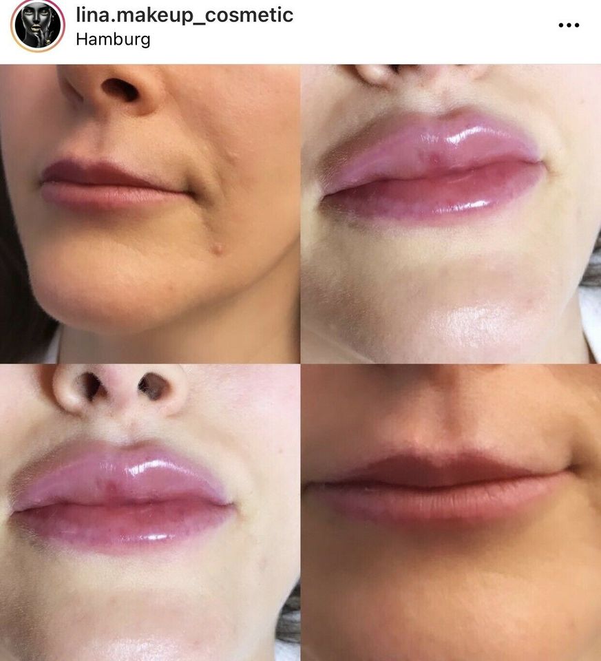 Original Russian lips Angebot 2ml 360€ Falten & fett-weg in Hamburg