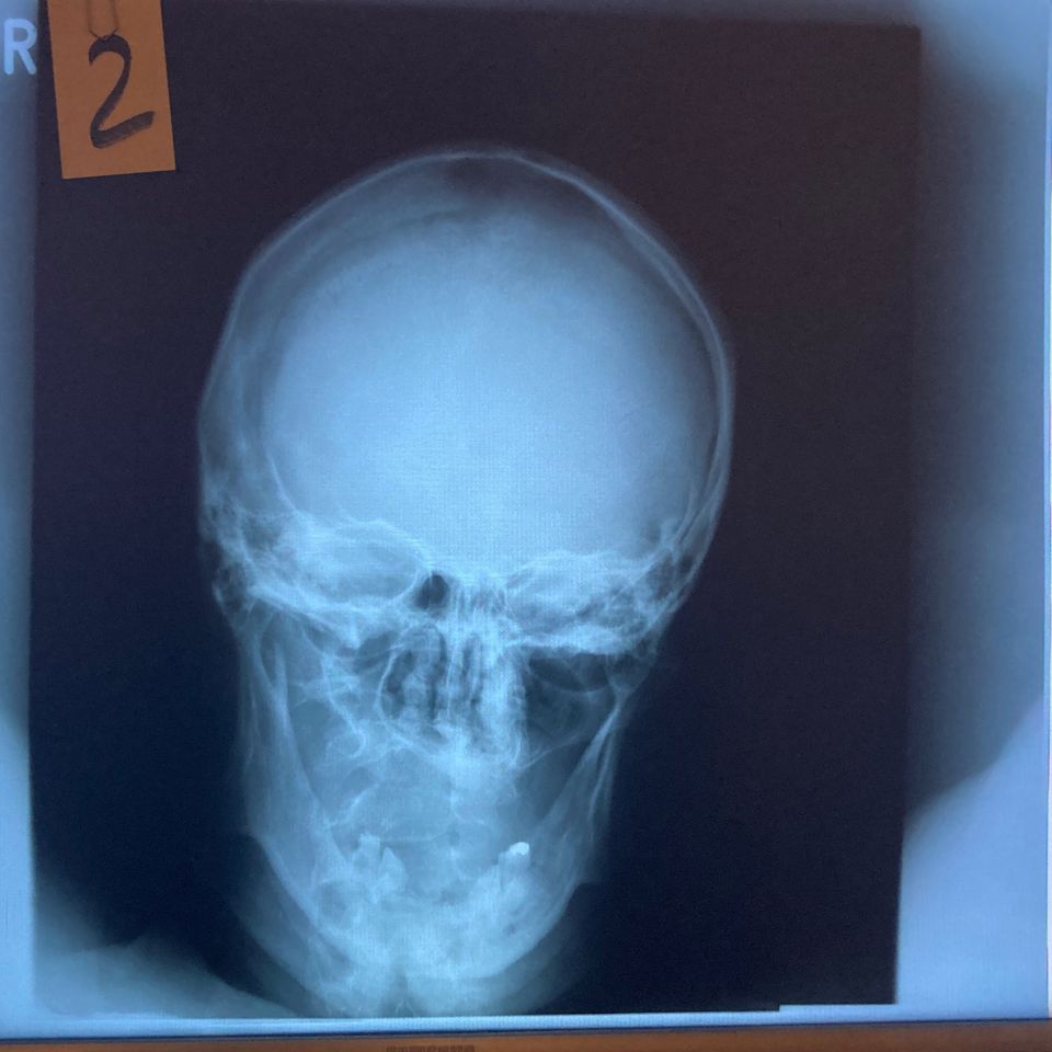 Röntgenbilder Schädel frontal (A) als Deko/für Schulungszwecke in Berlin