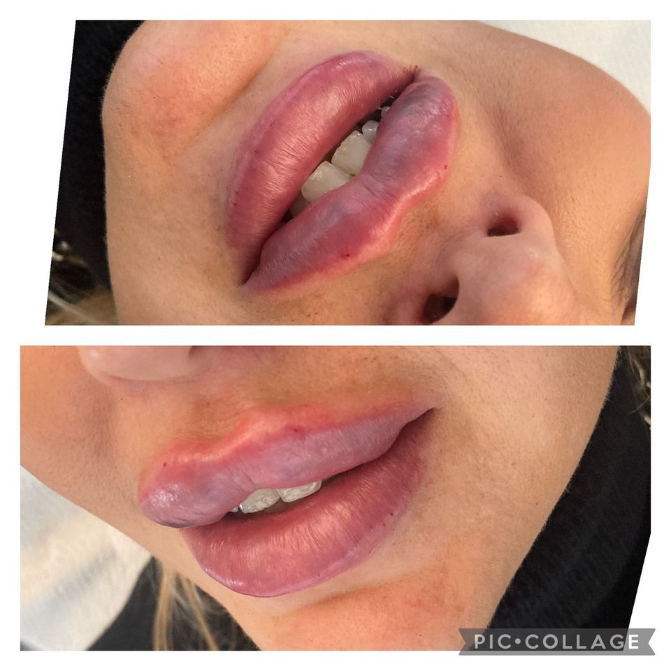 Lippen- & Faltenunterspritzung * Contouring in Hamburg