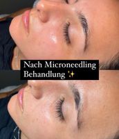 Microneedling + BB-Glow Modelle gesucht Baden-Württemberg - Helmstadt-Bargen Vorschau